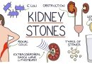 What are the 3 symptoms of kidney stones